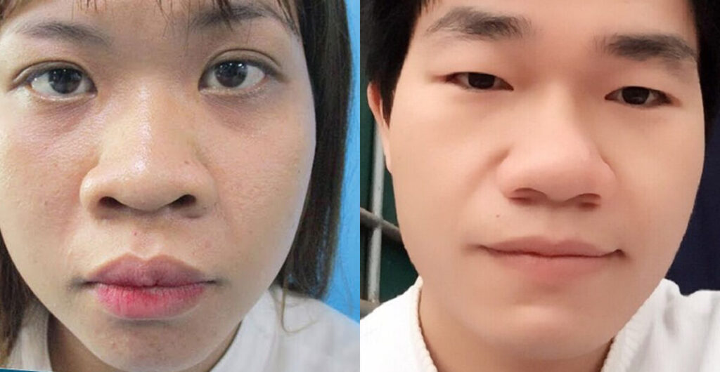 Khuyết điểm dáng mũi to